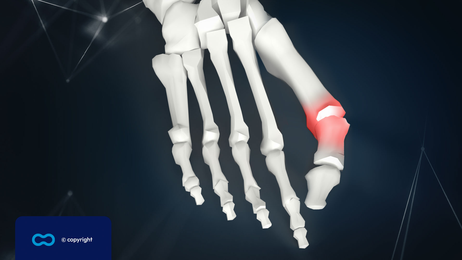 Brede schoenen voor Hallux Valgus